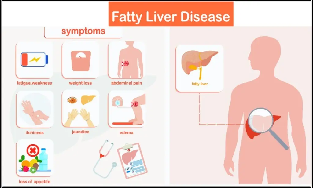 symptoms of fatty liver disease